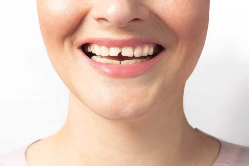 Chipped Tooth
